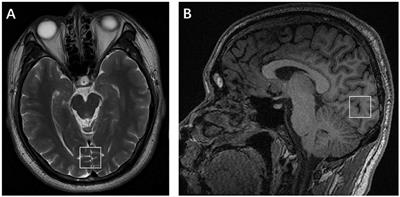 Altered Metabolites in the Occipital Lobe in Migraine Without Aura During the Attack and the Interictal Period